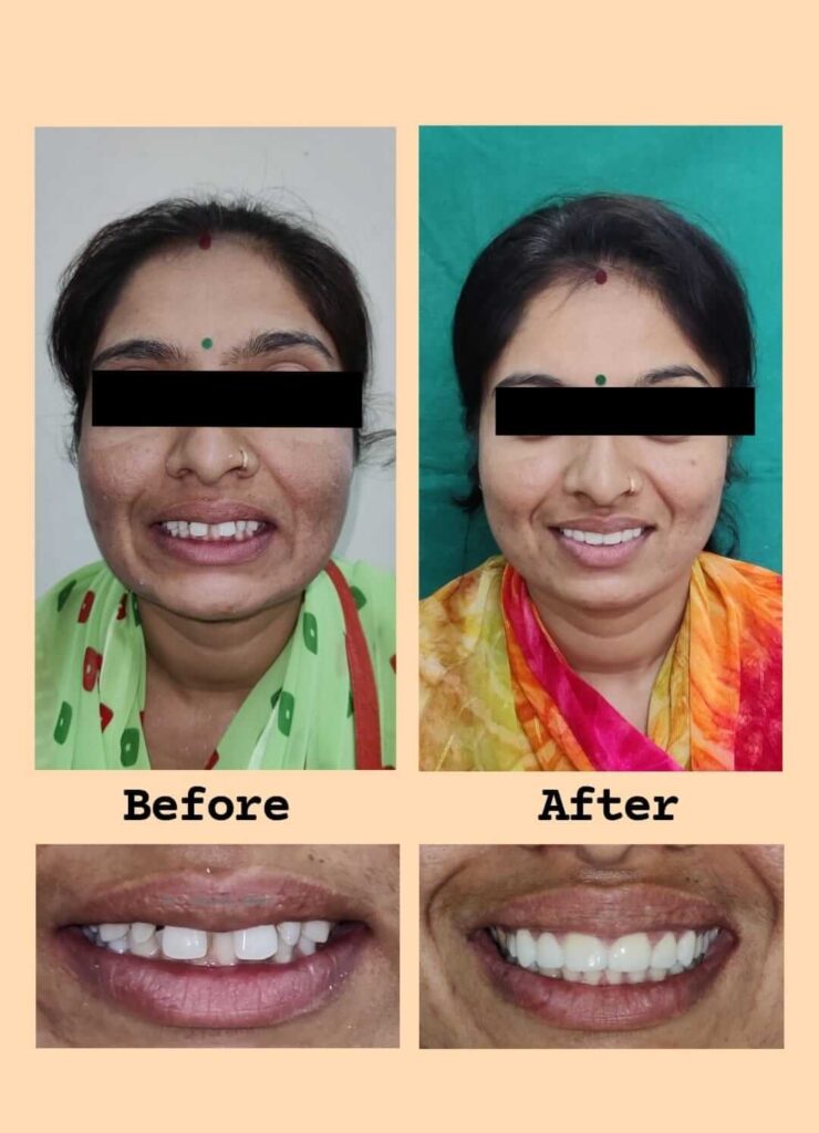 Wisdom Tooth Removal Bright Dental