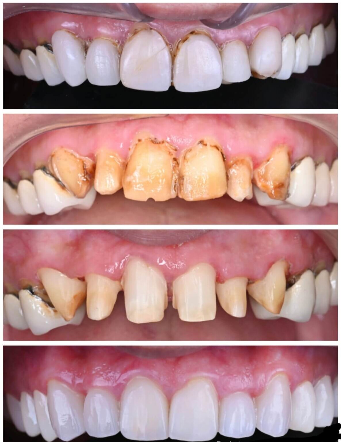 Advanced Periodontal Surgeries Bright Dental